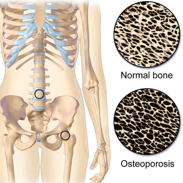 Get screened for osteoporosis using DEXA scans