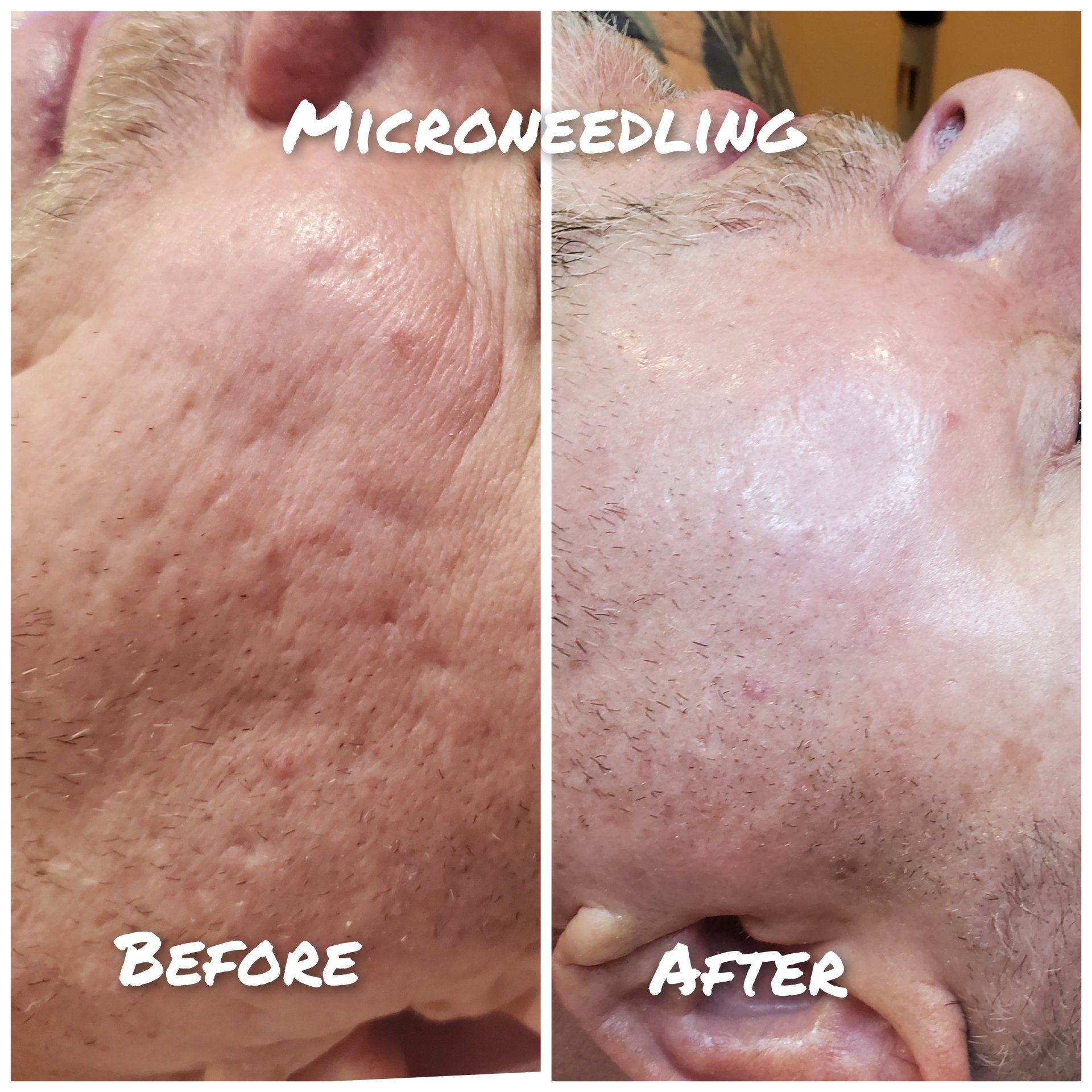 Facial Cleaning Treatment — Fort Lauderdale, FL — J. Cohen's Day Spa