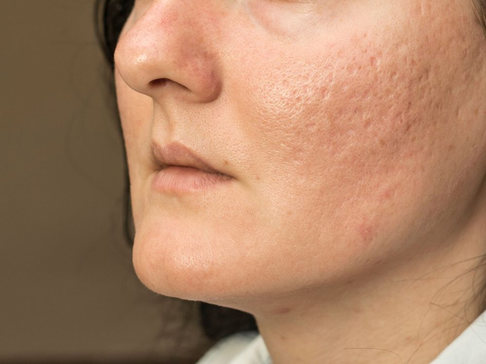 A close-up of a woman's face with acne on it.