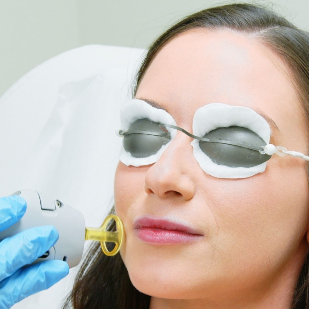 A woman is getting a laser hair removal treatment on her face.