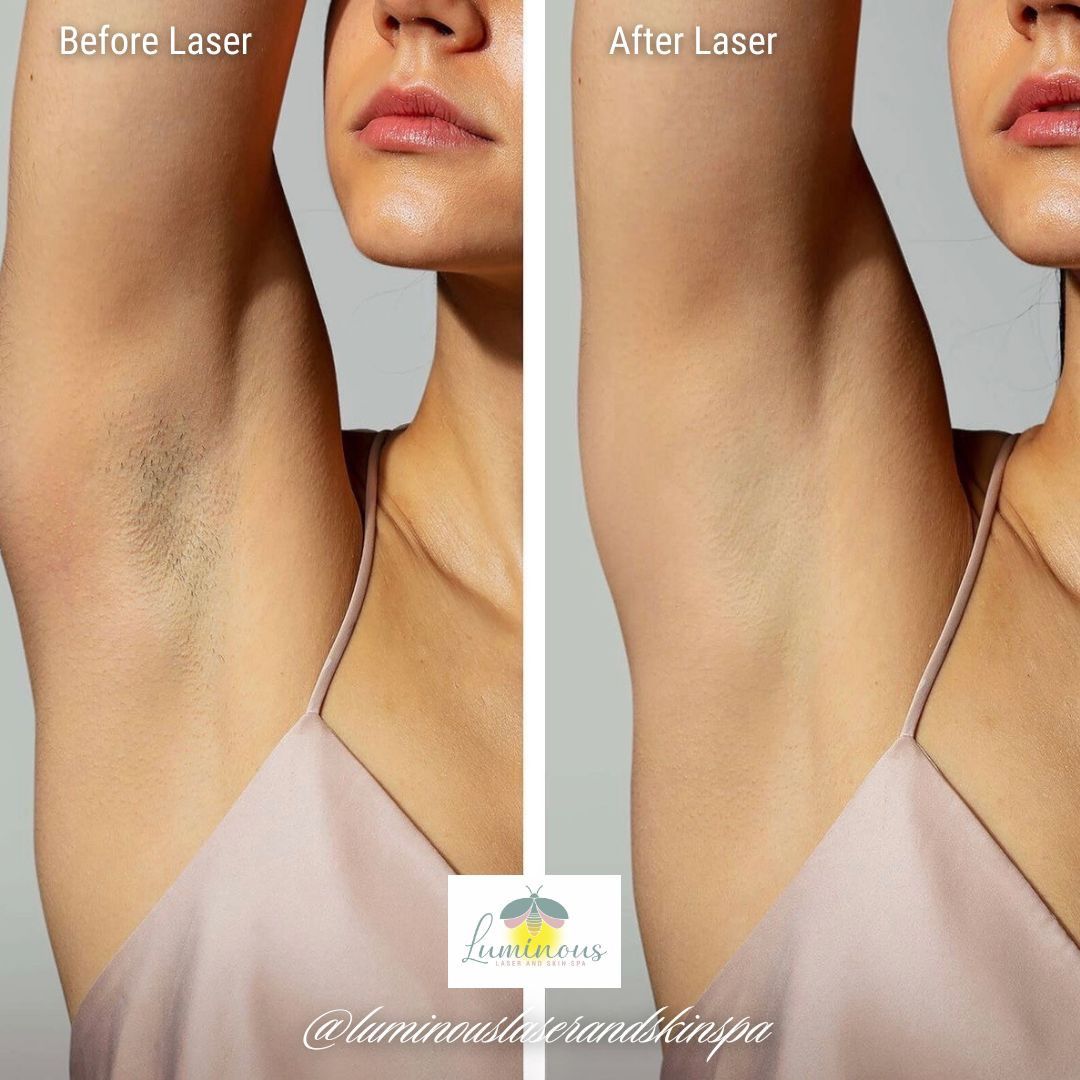 A woman 's underarm before and after laser hair removal