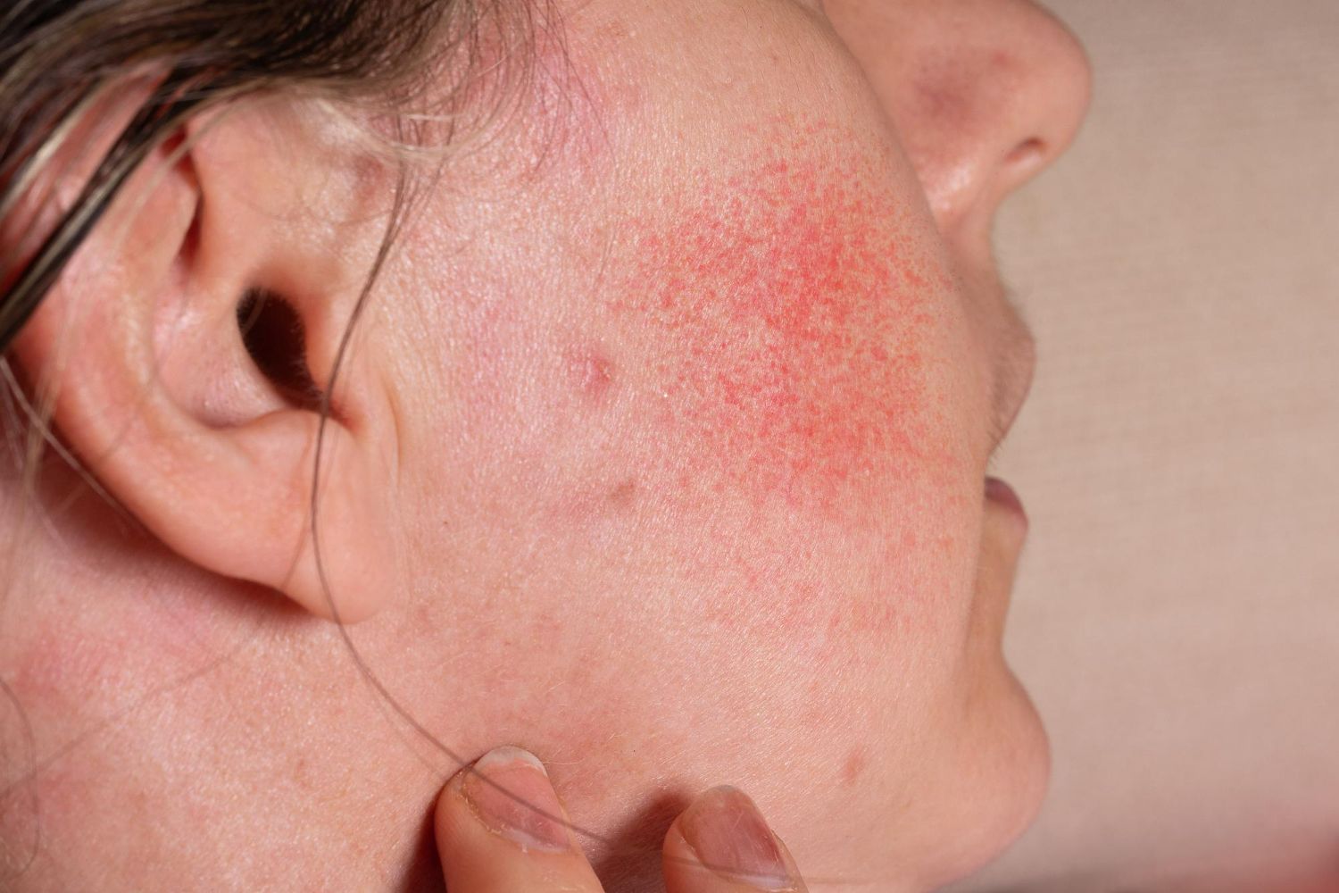 A close up of a woman 's face with red spots on it.