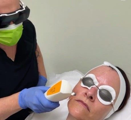 A woman is getting a laser hair removal treatment on her face.