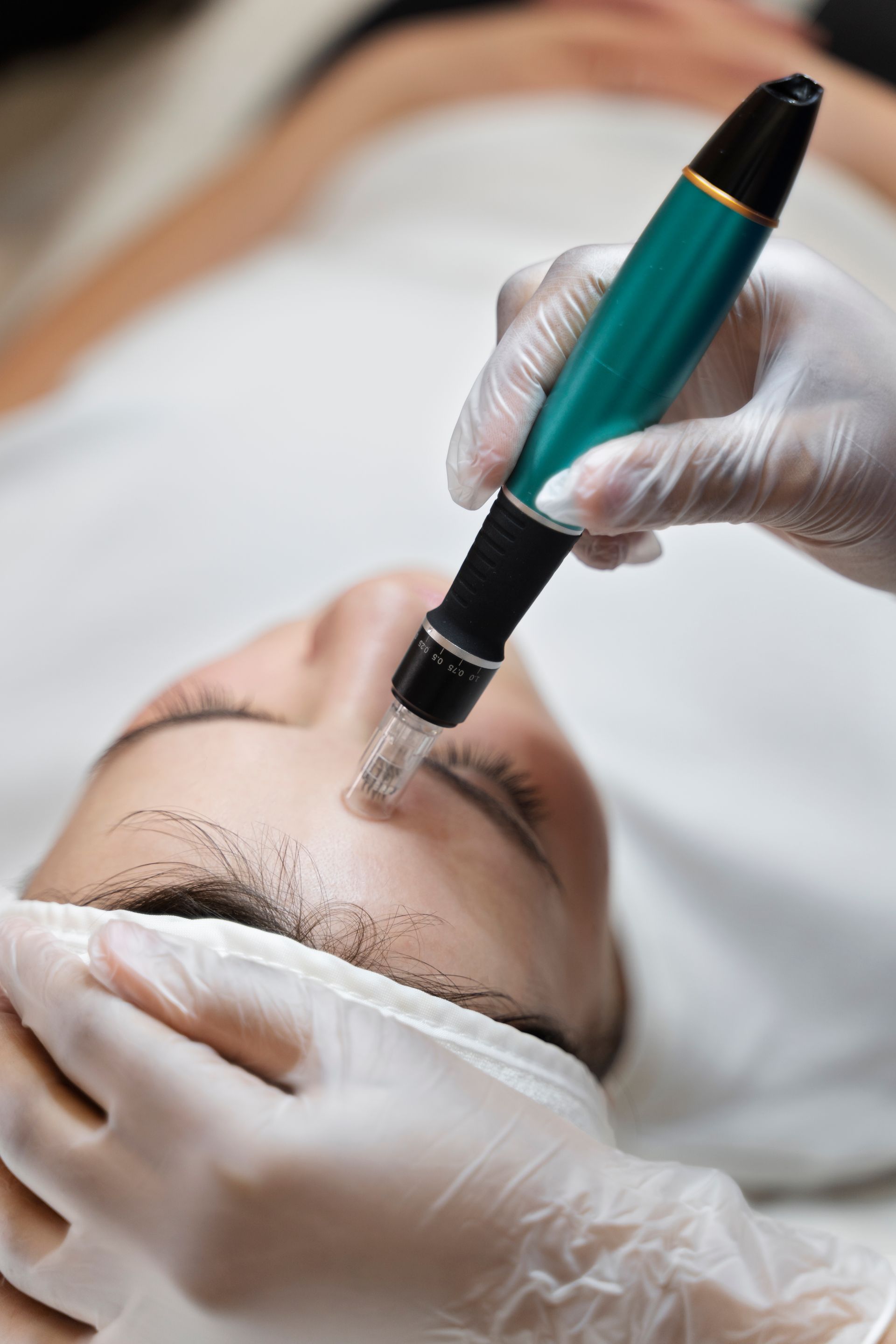 A woman is getting a microneedle treatment on her face.