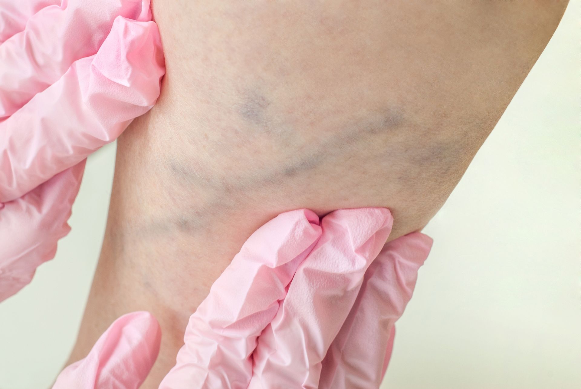 A person wearing pink gloves is examining a woman 's leg with varicose veins.