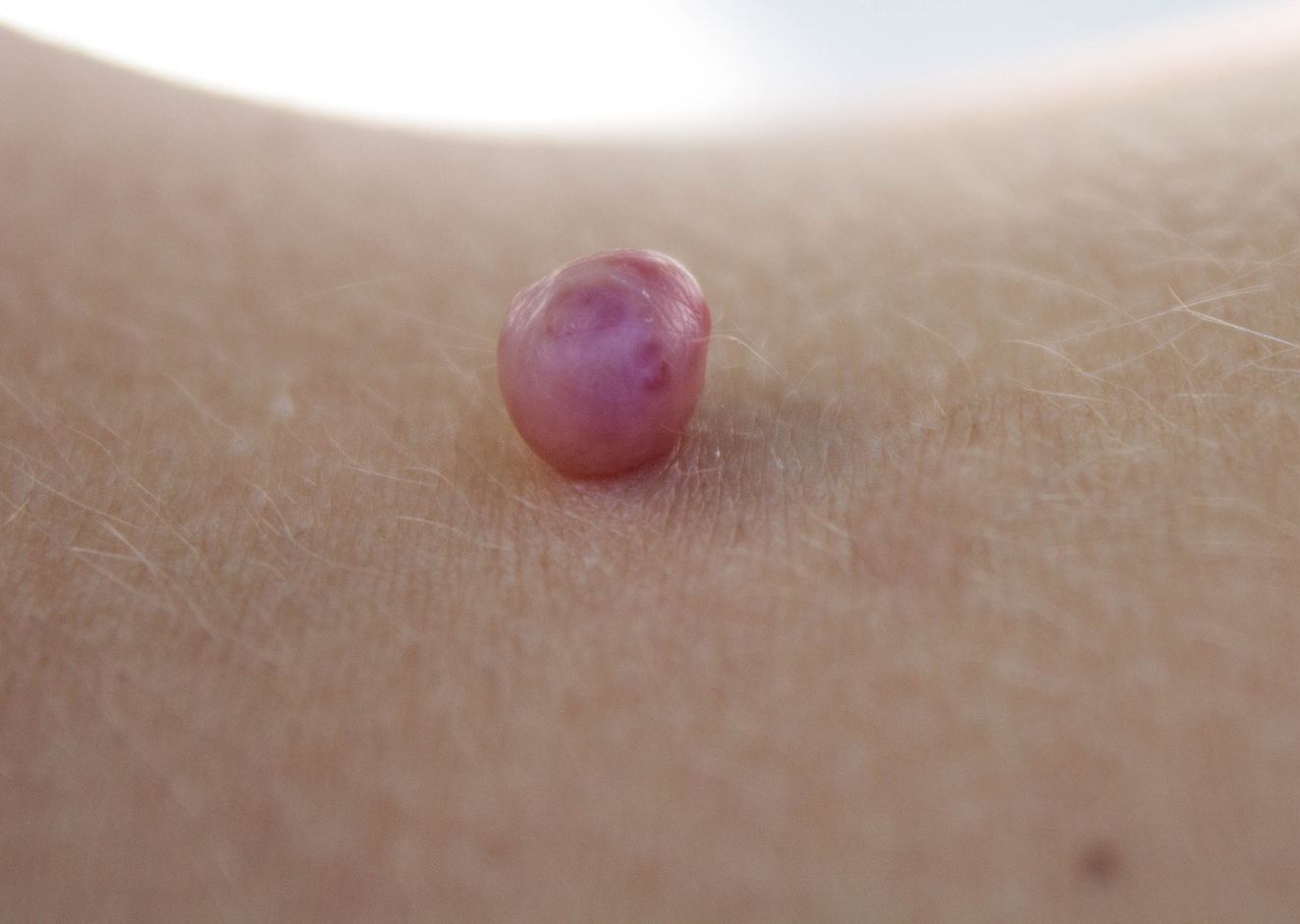 A close up of a pink spot on a person 's skin.