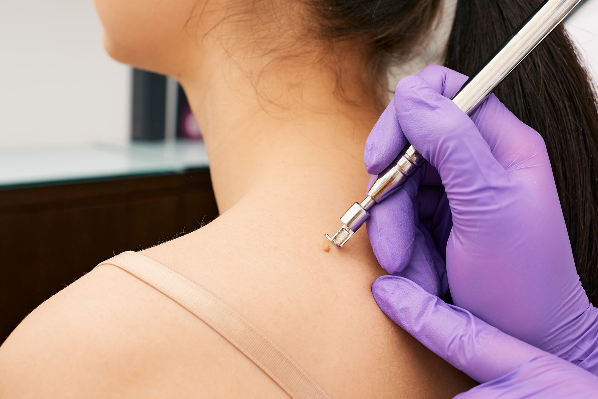 A woman is getting a wart removed from her back.