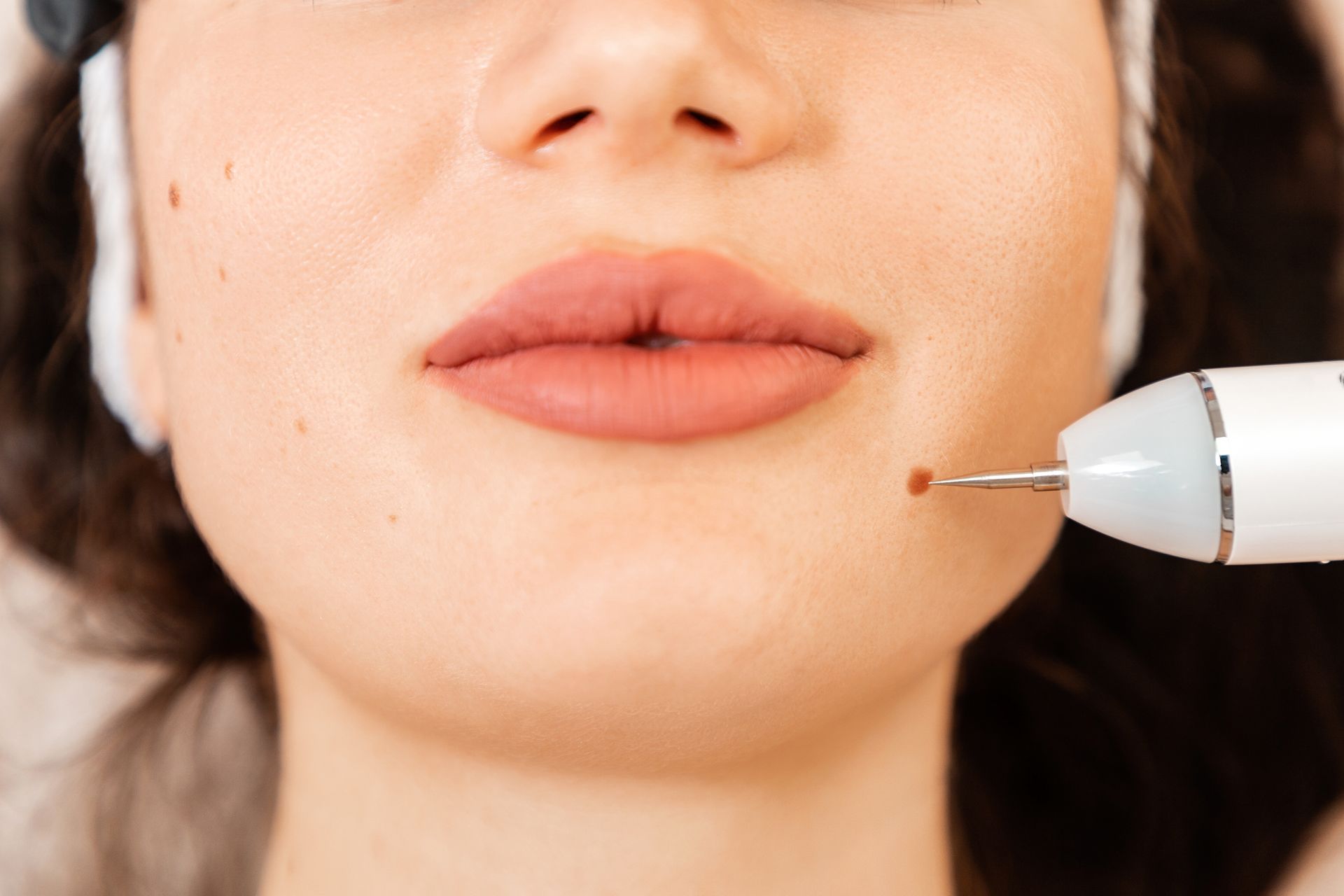 A woman is getting a laser treatment on her face.