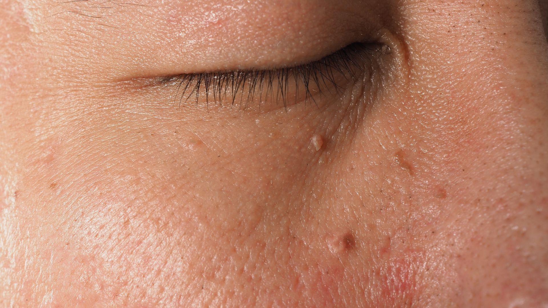 A close up of a woman 's eye with a few spots on it.