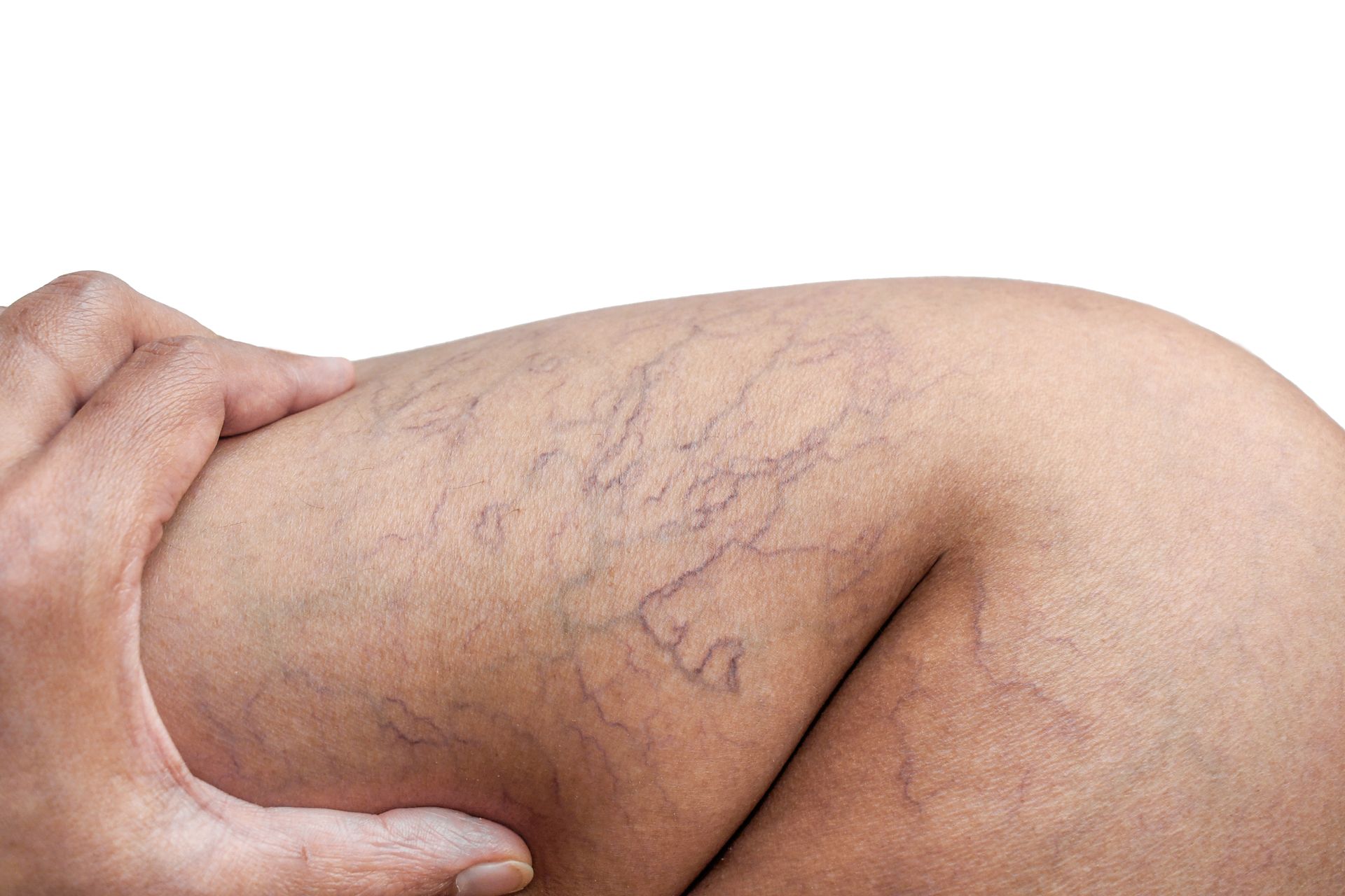  A person's  leg with spider veins.