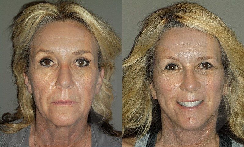 Before and after facial cosmetic procedure: woman's face, skin appears smoother and lifted on the right.
