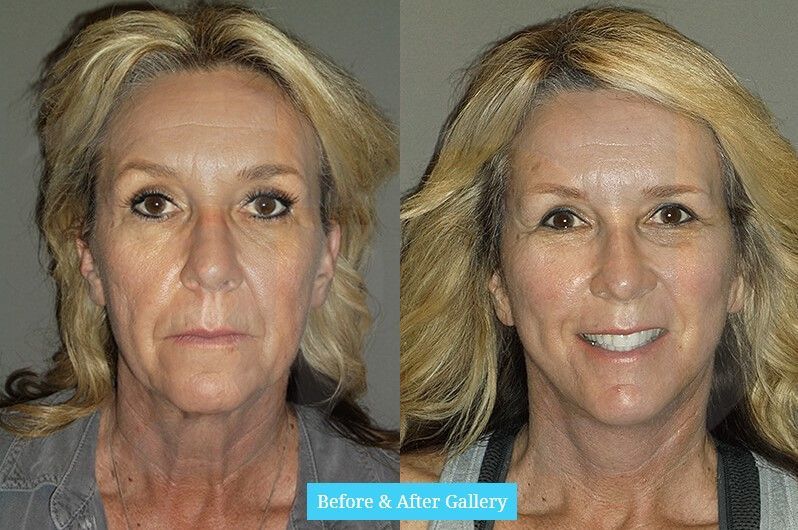 Side-by-side comparison of a person's face before and after a cosmetic procedure. The 