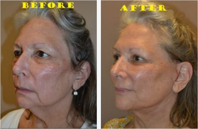 Comparison of woman's face before and after a cosmetic procedure; skin appears tighter and smoother in the 