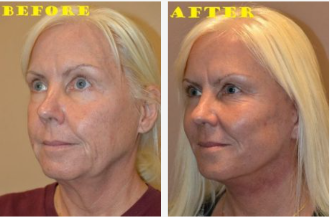 Side-by-side comparison: woman's face before and after cosmetic surgery. Skin appears smoother, with less visible wrinkles.