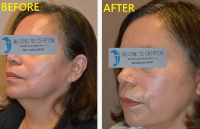 Side-by-side comparison of a person's face before and after a cosmetic procedure, showing a smoother appearance.