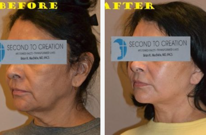 Side-by-side comparison of a person's face before and after a cosmetic procedure, showing a visible neck lift.