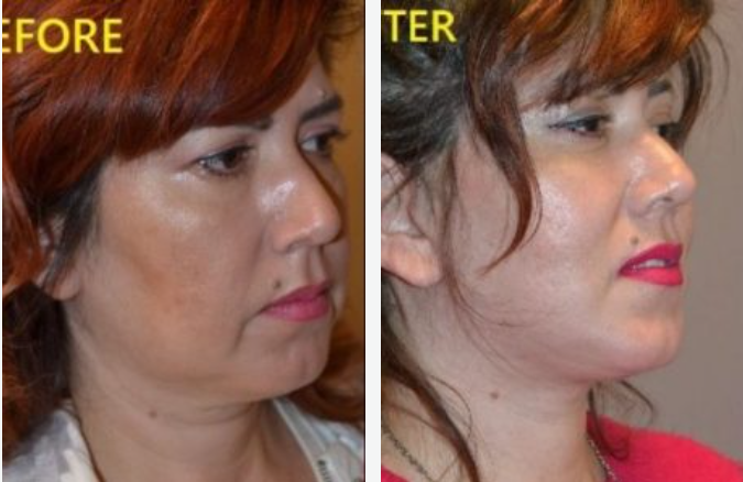 Comparison of a woman's profile before and after a cosmetic procedure, showing a refined jawline.