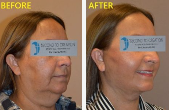 Side-by-side comparison of a person's face before and after a cosmetic procedure, showing reduced sagging.