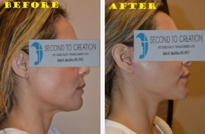 Side-by-side comparison of a person's profile before and after cosmetic surgery, showing a tighter jawline.