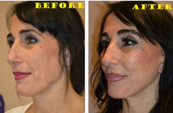 Before and after photos of a woman's face, showing skin rejuvenation.