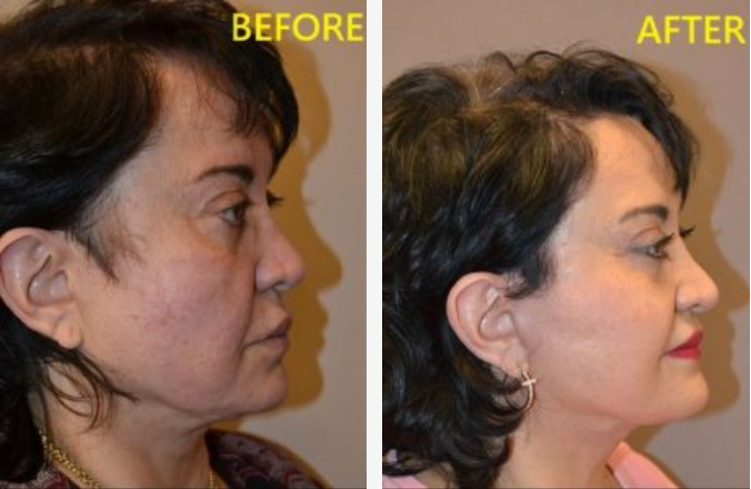 Side-by-side comparison. Woman's face before and after a cosmetic procedure, showing a more defined jawline.
