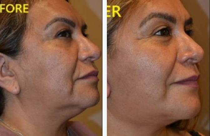 Side-by-side photos show a woman's face before and after a cosmetic procedure, with reduced wrinkles and tighter skin.