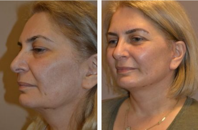 Before-and-after photos of a woman's face, showing a smoother and tighter appearance after a procedure.