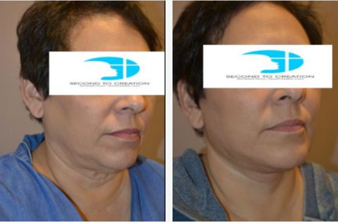 Before-and-after photos of a person's face and neck, showing reduced wrinkles and improved jawline definition.