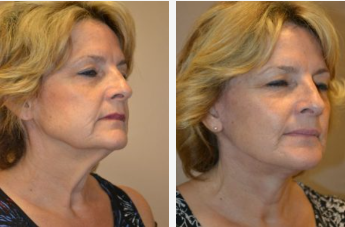 Before and after photos of a woman's face, showing a facelift's effect on neck and jawline.
