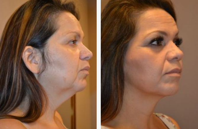 Before and after views of a woman's face, showing a tightened jawline and reduced wrinkles.