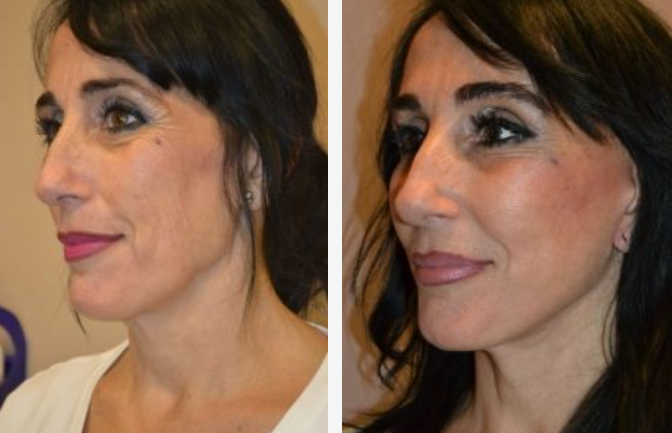Two side-profile views showing a woman's face before and after cosmetic procedures, with visible skin changes.