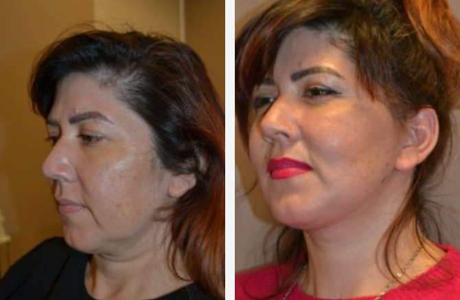 Side-by-side comparison of a person's profile: before and after apparent cosmetic work; improved jawline and skin tone.