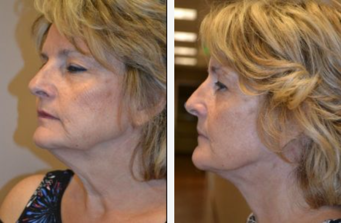 Side-by-side photos of a woman's face, showing a visible neck lift result with smoother skin and reduced sagging.