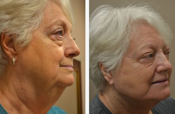 Side-by-side comparison of woman's face before and after cosmetic procedure, showing less neck sagging and tighter skin.