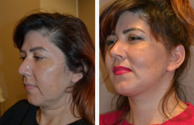 Two side-profile views of a woman's face, showing a before-and-after comparison. One appears aged, the other smoother.