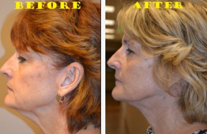 Side-by-side comparison: woman's profile before and after cosmetic surgery. Skin appears tighter, smoother in 