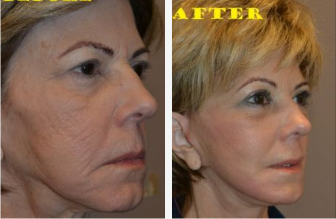 Side-by-side comparison: Before and after facial cosmetic procedure, showing reduced wrinkles and smoother skin.