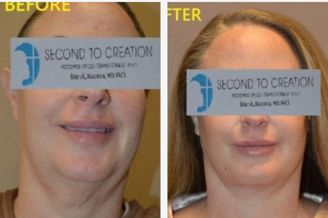 Before and after facial rejuvenation photos. Reduced neck and jowl sagging, improved skin appearance.