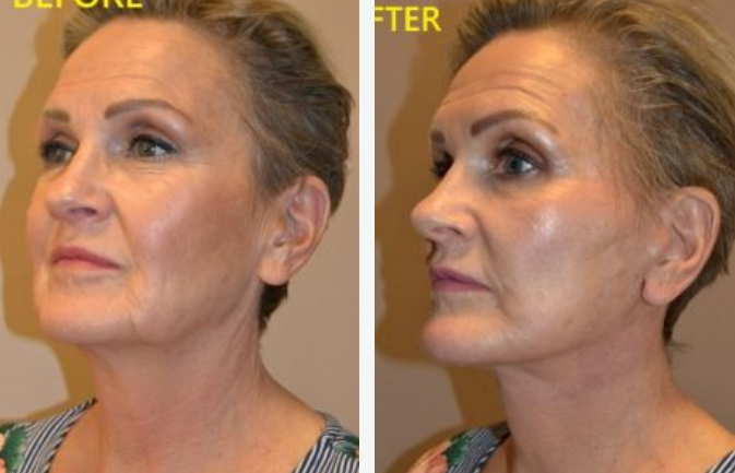 Before-and-after facial comparison. Woman's face and neck showing reduced wrinkles and tighter skin.
