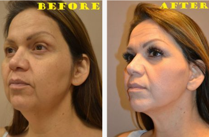Side-by-side comparison: before and after facial cosmetic procedure, highlighting changes to jawline and eye area.