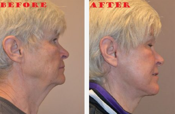Comparison of a woman's profile before and after a cosmetic procedure, showing a smoother neck.