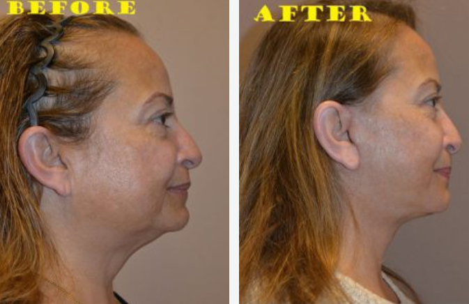 Side-by-side comparison: woman's face before and after a cosmetic procedure, showing a more defined jawline and neck.