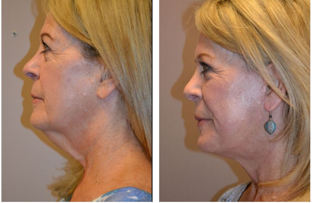 Before and after photos showing a woman's profile. Left: Sagging neck. Right: Tighter neck after a procedure.