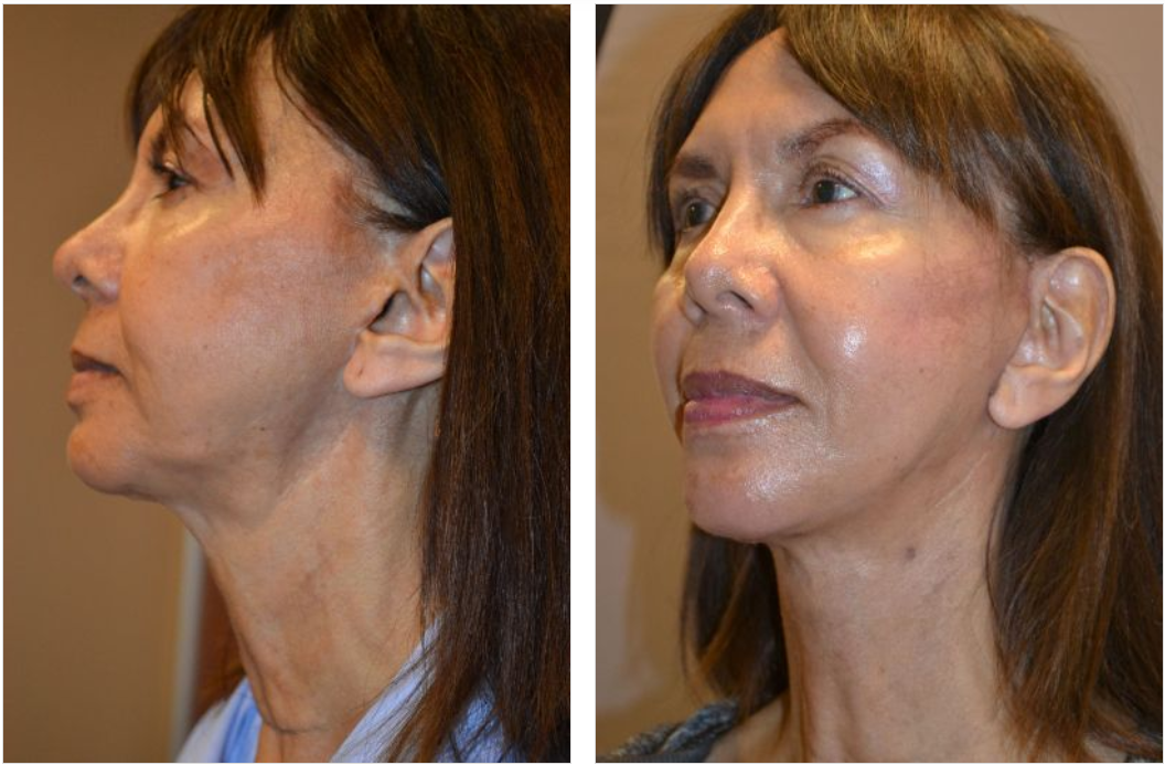Before and after photos of a woman's face, showing a facelift. The 