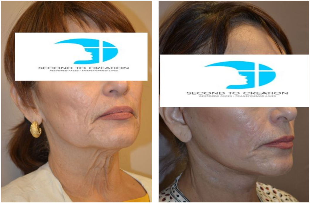 Side-by-side view of a face before and after a cosmetic procedure, showing reduced wrinkles and improved skin tone.