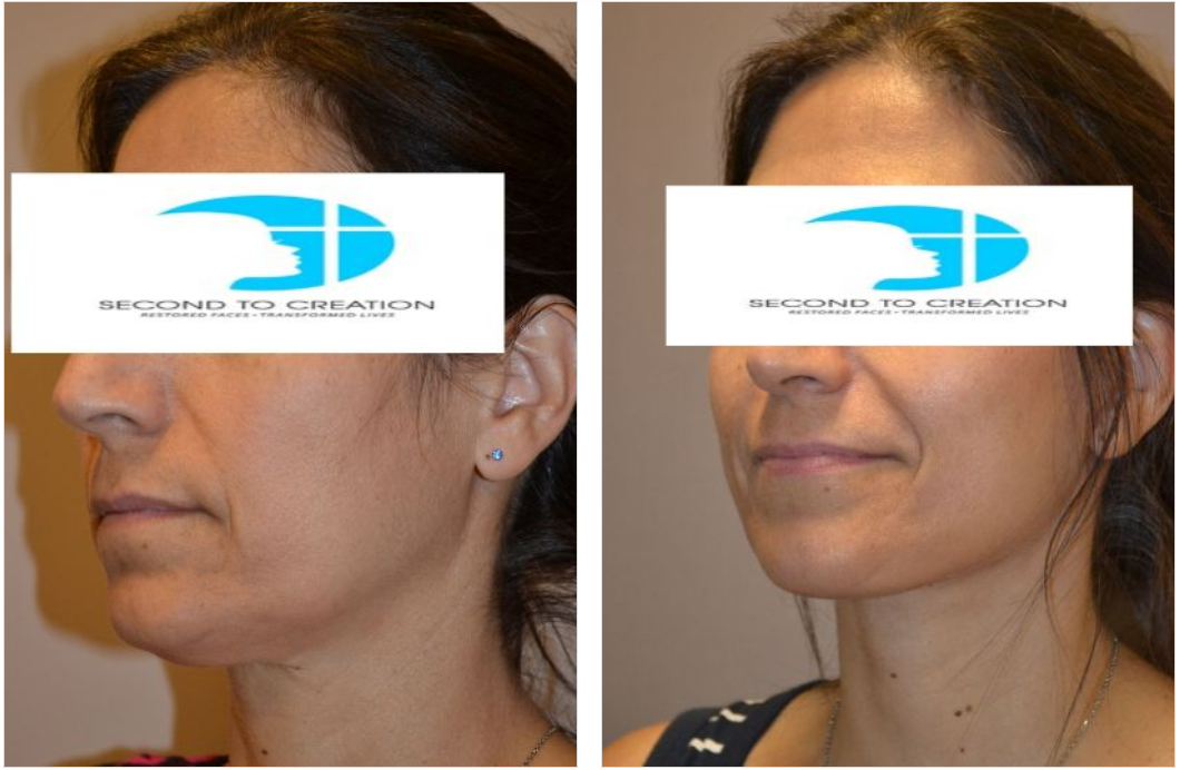 Before and after view of a person's face after a cosmetic procedure, showing a reduction in neck fat.