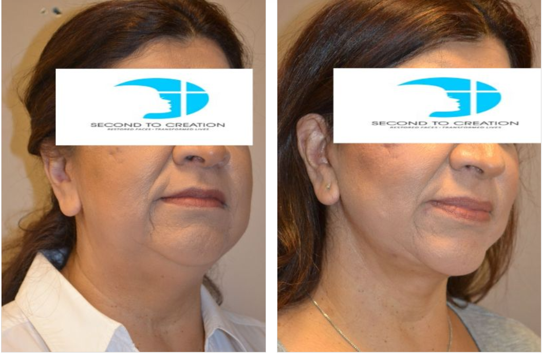 Before-and-after photos of a person's face and neck, showing a reduction in wrinkles and sagging skin.