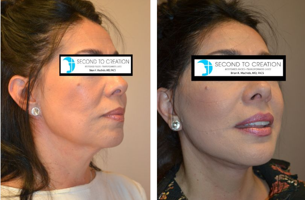 Before-and-after photos of a person's face. The after photo shows a tighter neck and more defined jawline.