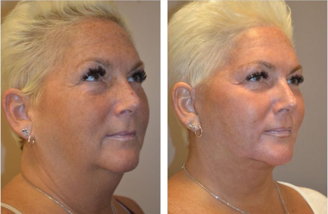 Side-by-side comparison: woman before and after cosmetic procedure; smoother skin, less sagging.