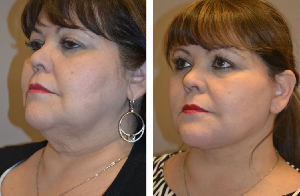 Before and after photos of a person's face after a cosmetic procedure to tighten the neck.
